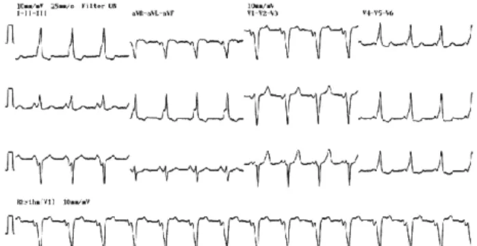 Fig. 1: Sinus rhythm in a patient with pre-excitation demonstrating accessory pathway conduction with a short PR interval and a delta