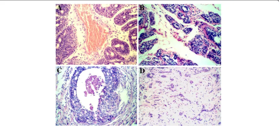 Figure 6 Breast sections of the different groups. A. Infiltrating ductal cancer in control group; B