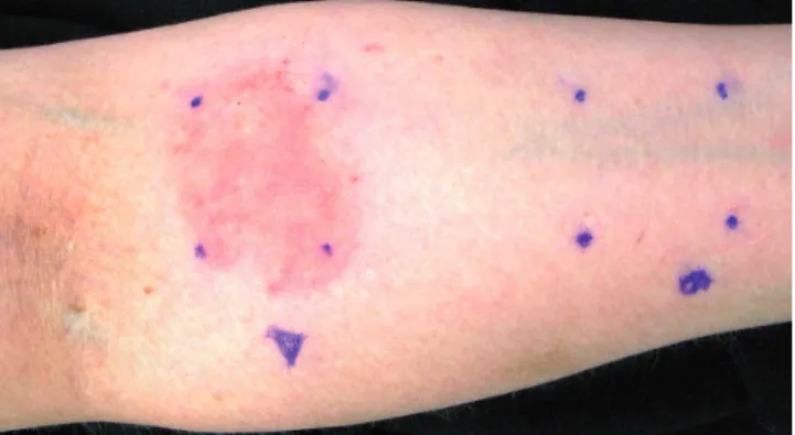 Fig. S1 1  illustrates the relationship between the patch  test reactivity towards sample A and the outcome of the  ROATs