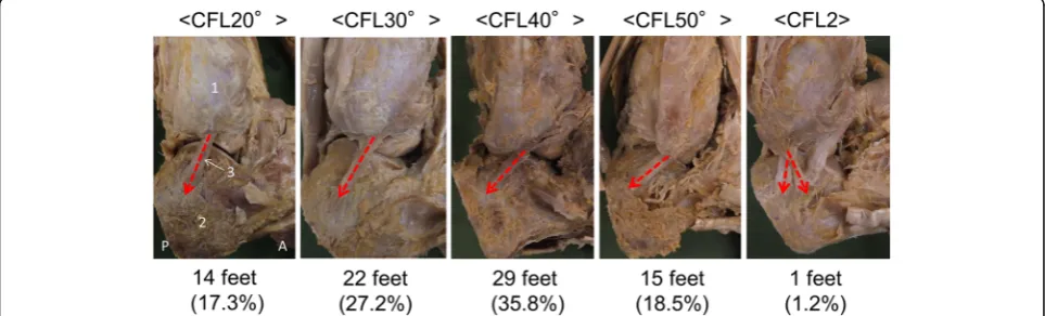 Fig. 2 Classification of calcaneofibular ligaments by running angle, right foot, lateral view