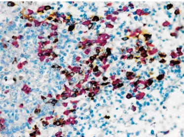 Figure 6.7 Sequential double staining method performed with the EnVi- EnVi-sion TM  G|2 Doublestain Kit using polyclonal anti-kappa light chains (red)  and polyclonal anti-lambda light chains (brown) as primary antibodies