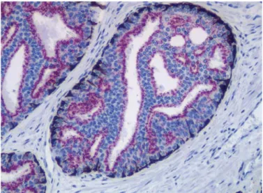 Figure  6.8  Simultaneous double staining performed with EnVision TM  DuoFLEX using an antibody cocktail containing monoclonal rabbit  anti-AMACR (red), monoclonal mouse anti-HMWCK and monoclonal  mouse anti-CK 5/6 (brown/black)