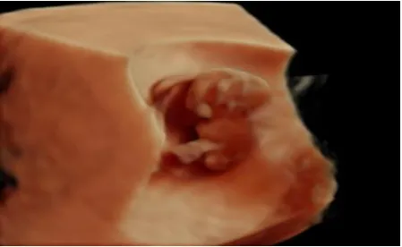 Figure 2: Six-week pregnancy. 