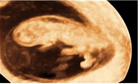 Figure 13: Triplet pregnancy. 