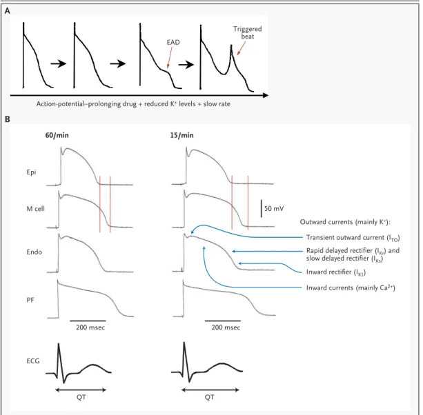 Figure 2. Postulated Basic Mechanisms in Arrhythmias Related to Long-QT Intervals.