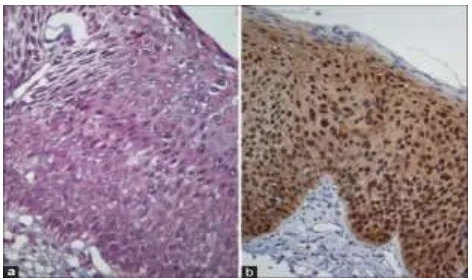 Figure 1: (a) Abnormal cervical cells stained by Papanicolaou method; (b) Cervical cells when immunostained for p16INK4a by cytospin for Human Papilloma Virus