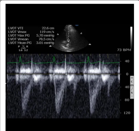Fig. 1 Example image of pulse wave Doppler in the LVOT andmeasurement of VTI tracing