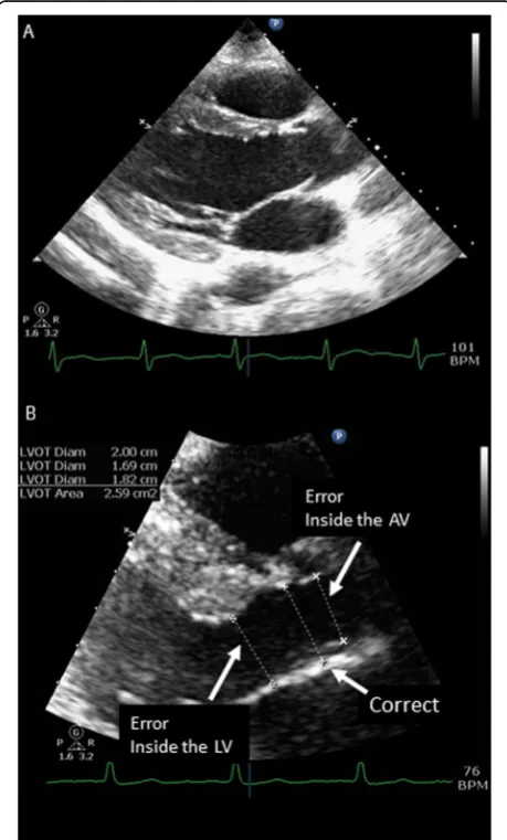 Fig. 2 Panel a: Example of ideal image obtained in parasternal longat initiation of systole, Panel b:ss Magnification of LVOT andexamples of common errors in measurement