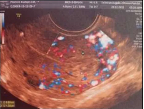 Figure 2: Ultrasonography of polyp with vascular pedicle. 