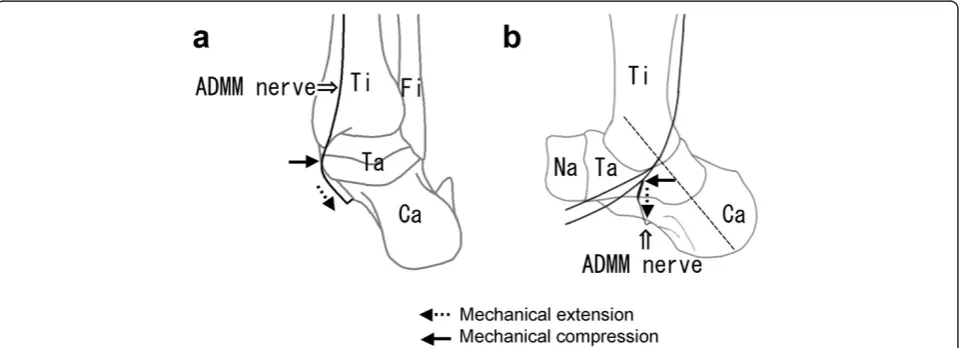 Fig. 4 A schematic drawing of the mechanical extension and compression of the nerve to the abductor digiti minimi muscle (aADMM nerve)