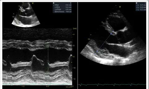 Fig. 3 This image in parasternal long-axis view illustrates some limitations of the M-mode method of measuring LV dimension and wall thicknessin some patients