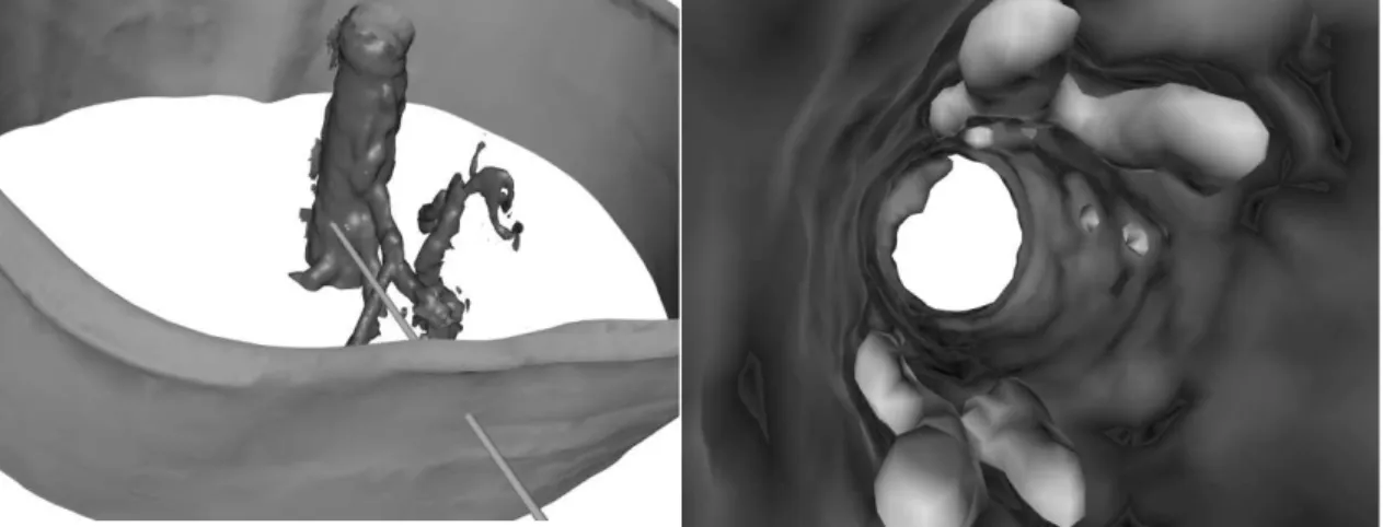 FIGURE 6. The aorta viewed from outside. The cylinder shows the