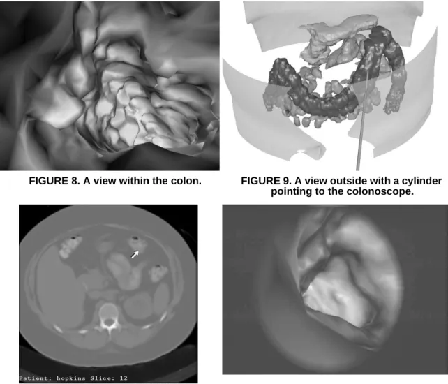 Figure 8 shows a view within the colon. For interior views, we do not decimate the models.