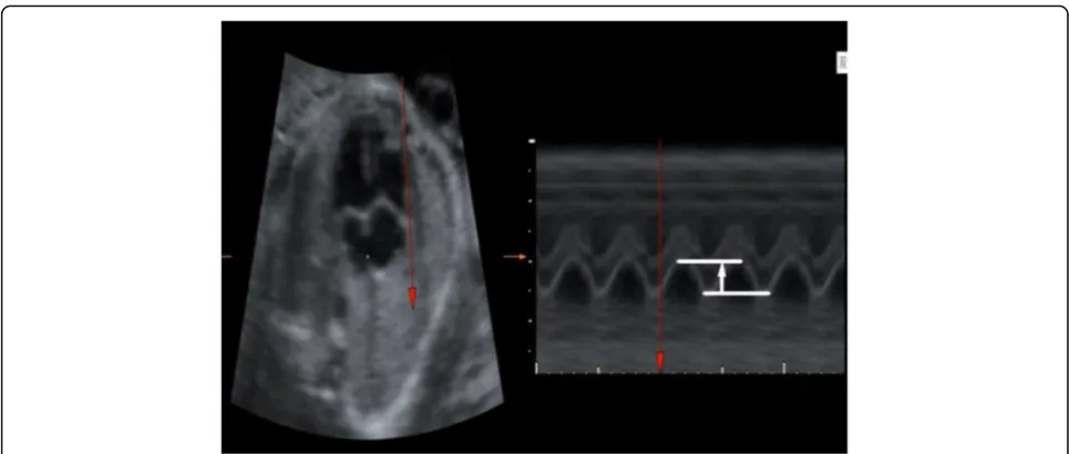Fig. 1 Measurement of spatiotemporal image correlation (STIC) M-mode fetal tricuspid annular plane systolic excursion (f-TAPSE) vertically, parallelto the interventricular septum