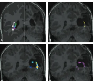 FIG 2. Assessment of the OR in patient 14 with a right hippocampal sclerosis. Results of prob-abilistic tractography (A) for the right Meyer loop (arrowhead) and (B) for the main part of theOR are shown