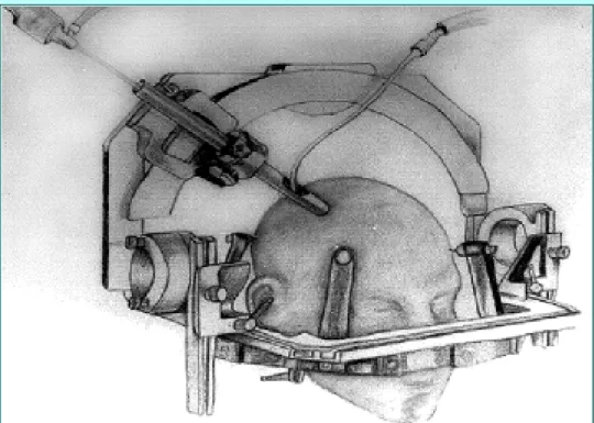 Fig. 1. Artist's rendering of the stereotactic endoscopic system. An Otzuki guiding cannula (8 mm in diameter, 20 cm long, with a 1 X 2 cm side window) is attached to a stereotactic Codman-Roberts-Wells headframe using a specially designed stereotactic gui