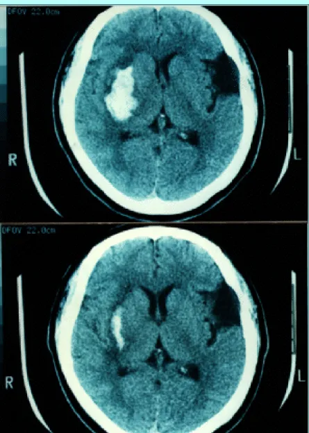 Fig. 3. Case 15. Computerized tomography (CT) scans obtained in a 54-year-old man with a right putaminal intracerebral hemorrhage