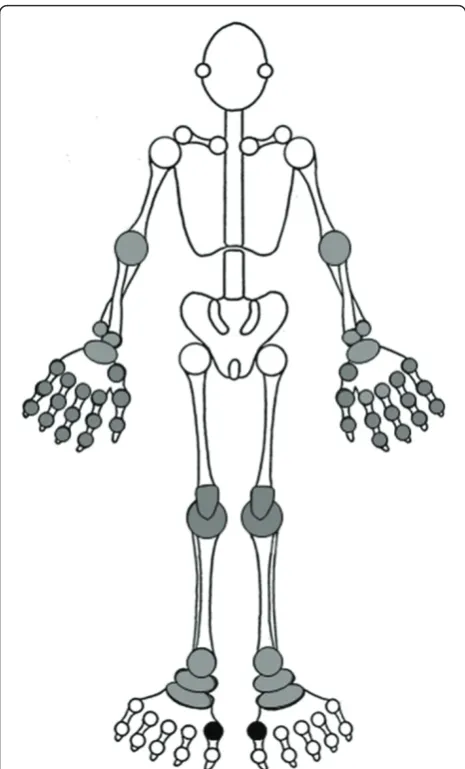 Figure 1 Distribution of joints typically affected by gout(reproduced with the permission of the author and the RoyalCollege of General Practitioners: Roddy E, Doherty M