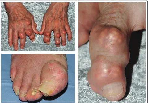 Figure 2 Tophaceous gout affecting the right great toe and finger interphalangeal joints