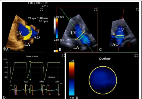 Fig. 2 CO assessment using 3DCF transthoracic echocardiography. 3DCF images were obtained in the apical long axis view (panel a)
