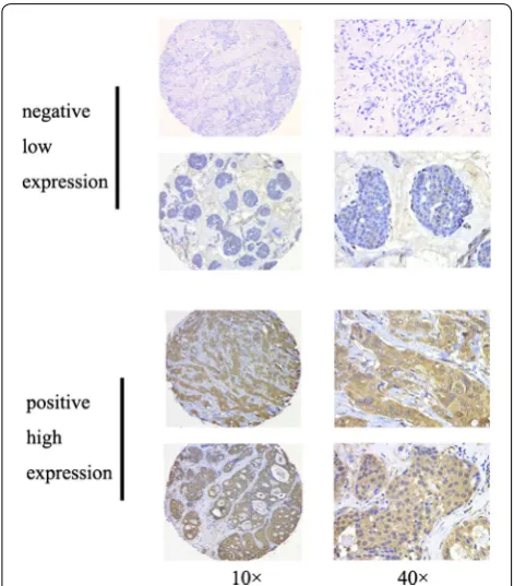 Table  3clinicopathological variables analyzed using univariate  presents the association between OS and the and multivariate Cox regression