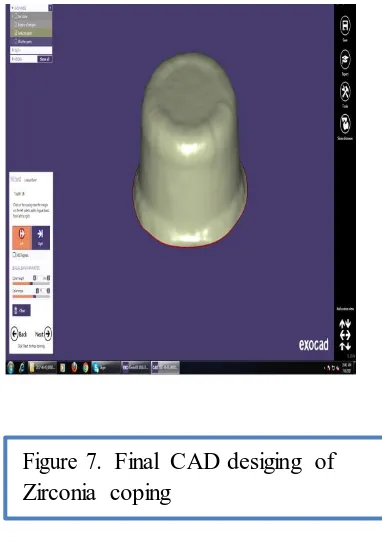 Figure 7.  Final CAD desiging of Zirconia coping 