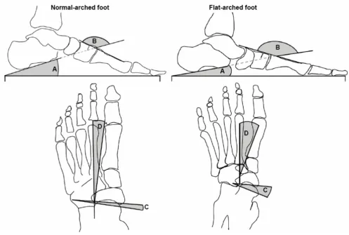 Figure 3Traces from two representative participants illustrate x-ray angular measurements from normal (left) and flat-arched (right) flat-arched foot posture; angle B, C and D B - calcaneal-first metatarsal angle, C - talo-navicular coverage angle, D - tal