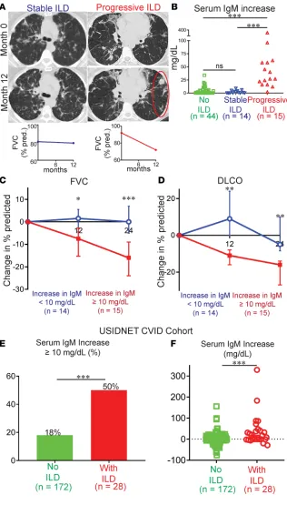 Figure 1. Increase of serum IgM distinguishes CVID patients with progressive ILD. (A) CT chest scans from CVID patients with stable or progressive ILD over a 12-month period (area of worsening inflam-mation is circled) and corresponding FVC measure-ments
