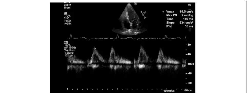 Fig. 1 Acceleration rate of E wave of mitral inflow