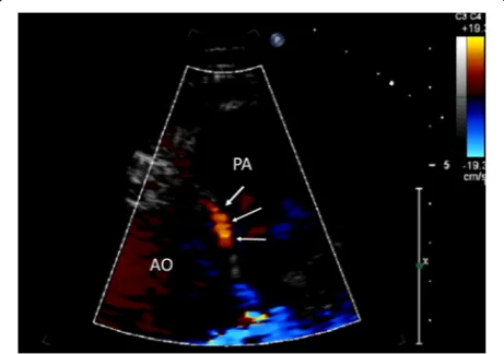 Fig. 2 Abnormal right coronary artery from the opposite sinus withinter arterial course (arrows)