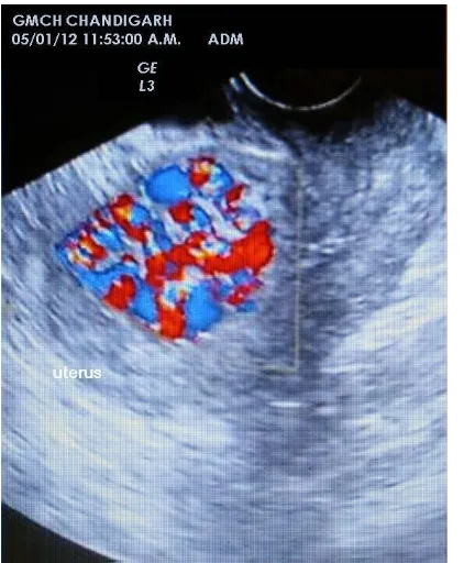Figure 2: Angiogram showing abnormal vascular pattern, right uterine artery.  