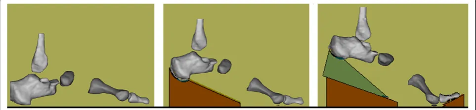Figure 3 Virtual bone models.system on wedges to simulate the gait midstance (MS), heel off (HO), and terminal stance (TS)