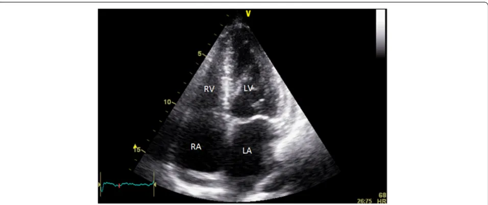 Fig. 8 Parasternal long view in systole (2 weeks post pericardiocentesis and development of LV dysfunction), showing resolution of both akinesisin the mid septum and apical ballooning (apex not well visulised here)