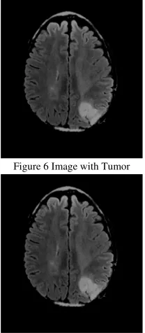 Figure 6 Image with Tumor 