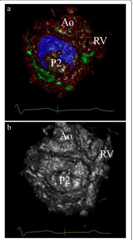 Fig. 9 Surgeon view of the mitral valve from a patient with A3/P33D VSAP.prolapse as presented on the holographic screen