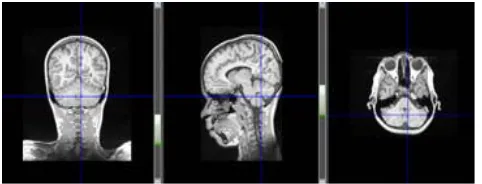 Figure 1 Different Isometric View of Original Brain Volume 