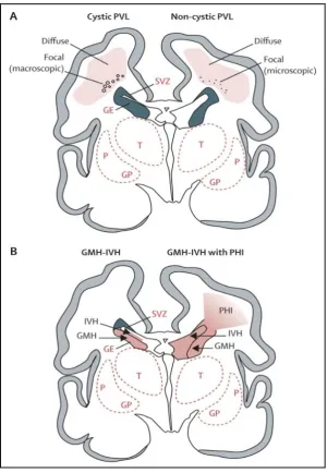 Figure 1.1: Cystic and noncystic periventricular leukomalacia (PVL) and germinal matrix haemorrhage-intraventricular haemorrhage (GMH-IVH) and GMH-IVH with periventricular haemorrhagic infarction (PHI).1  