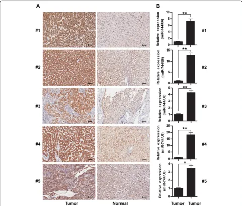 Figure 4 Expression analyses of miR-744 and c-Myc in HCC tissues. (A) Analysis of c-Myc expression in five HCC tissues and adjacent normaltissues by IHC
