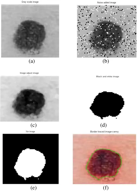 Figure 2. Demonstration of border detection for  Skin  Lesion 1 by the proposed  robust   segmentation  algorithm  (a) Gray scale image