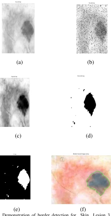 Figure 5(b) shows the final output results of the variational Figure 5(a). illustrates   the original skin lesion 3