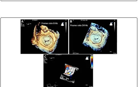 Figure 9 Quantitation of MR. Panel A: A vena contract >0.7 cm is consistent with severe MR