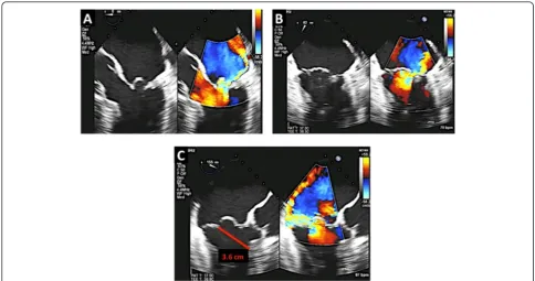 Figure 11 Using the MVQ 3D function one can appreciatethe shape of the mitral annulus