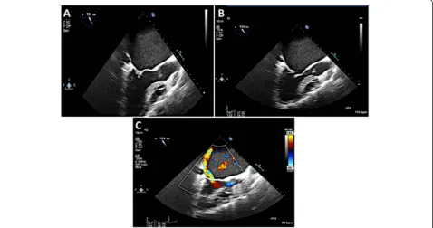 Figure 15 3D color and assessment of MR. A: In HVR mode, the location of the regurgitant jet can be identified