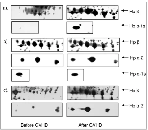 Figure 4GVHD after allo-HCT by Elisa assayComparison of serum Hp level in patient with and without Comparison of serum Hp level in patient with and without GVHD after allo-HCT by Elisa assay