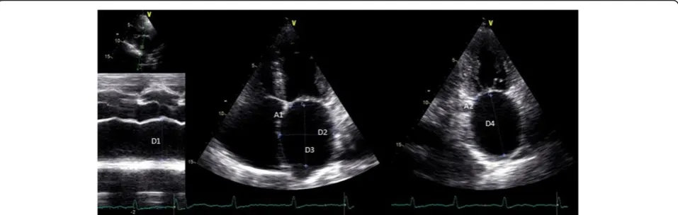Figure 1 Echocardiographic parameters used to calculate the left atrial volumes. Legend: A1 - LA area in 4C view; A2 - LA area in 2C view;D1 - LA AP diameter; D2 - medial–lateral diameter; D3 - superior-inferior diameter in 4C view; D4 - superior-inferior diameter in 2C view.