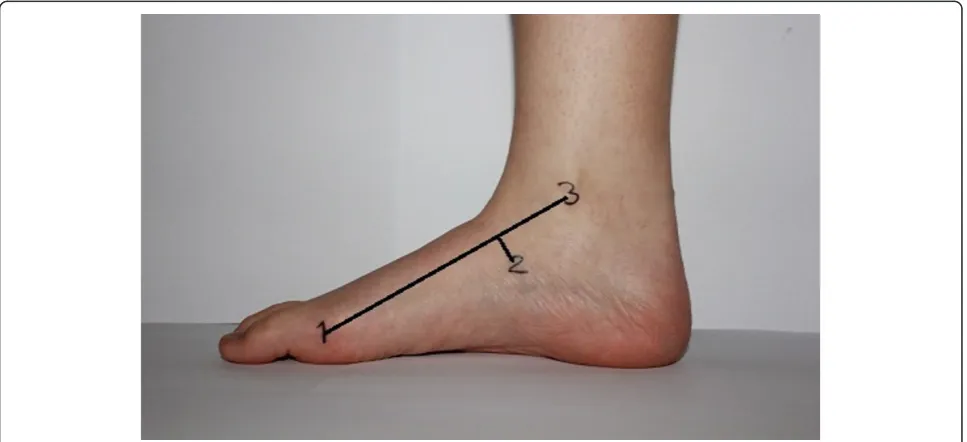 Figure 2 Longitudinal arch angle with the foot in subtalar neutral position. The foot was in its subtalar neutral position and the landmarks(1-3) were used to measure LAA