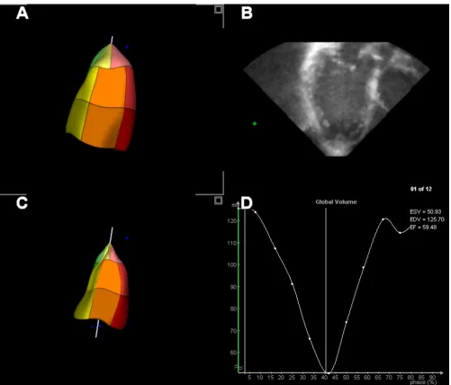 Figure 2views (B)End-diastolic (A) and End-systolic (C) reconstruction of the left ventricle after semi-automated border analysis of the long-axis End-diastolic (A) and End-systolic (C) reconstruction of the left ventricle after semi-automated border analy