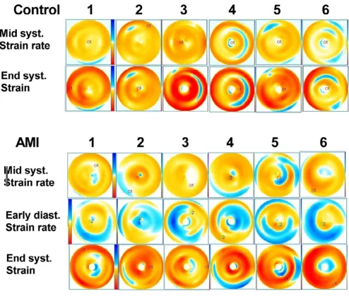 Figure 4Bull's eye views of all subjects in the studybottom rows are the infarction patients