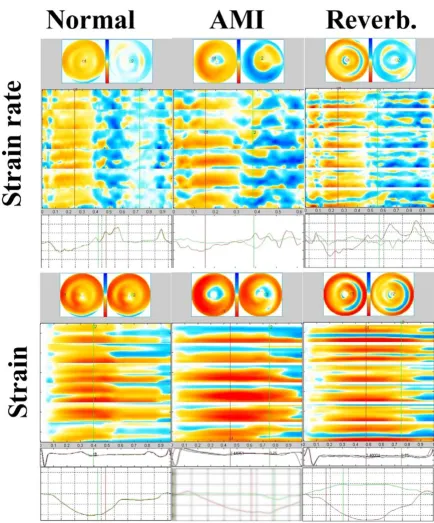 Figure 5The appearance of reverberations versus normal and pathological findingsby colour strain images