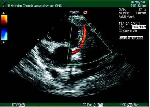 Figure 1Left main stem coronary artery and proximal segment of LAD in color-coded transthoracic Doppler echocardiography.